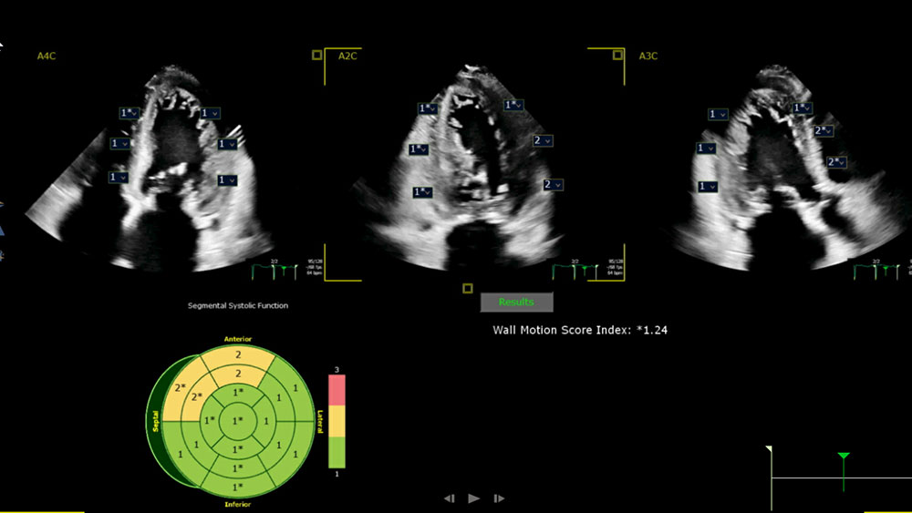 EPIQ CVx and Affiniti CVx with Segmental Wall Motion