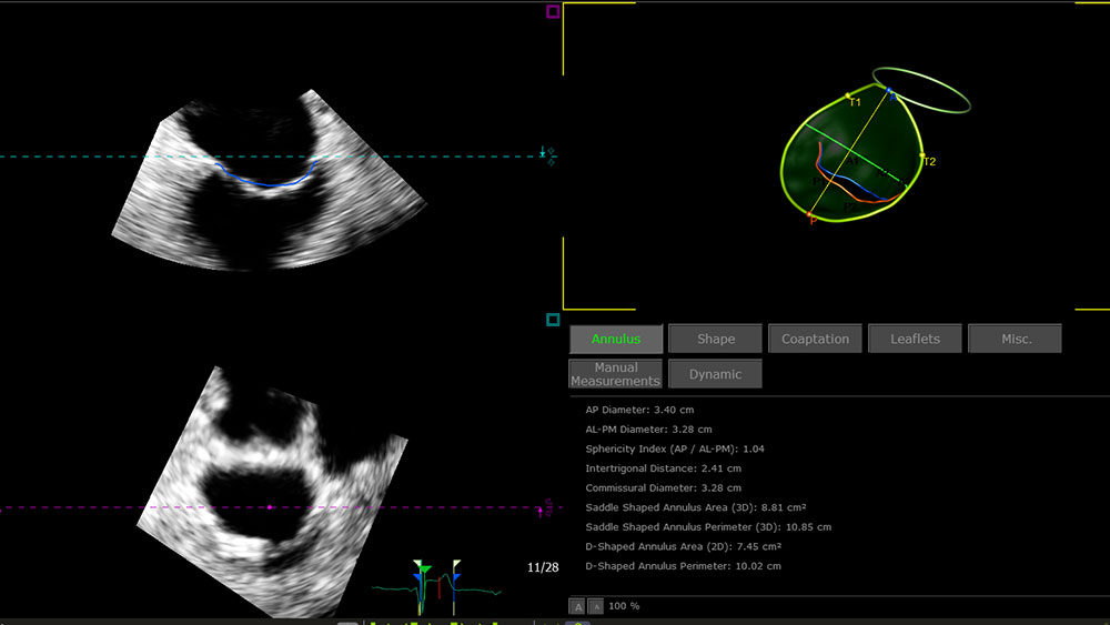 EPIQ CVx and CVxi with 3D Auto MV